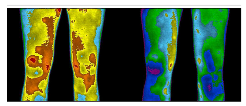 Thermal imaging demonstrating inflammation reduction after Earthing